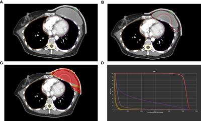 Individualized 3D-printed bolus promotes precise postmastectomy radiotherapy in patients receiving breast reconstruction